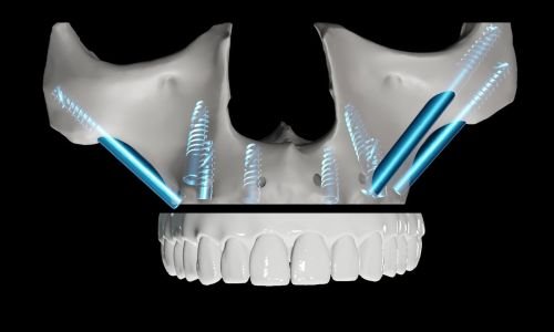 Zygomatic Implants 1